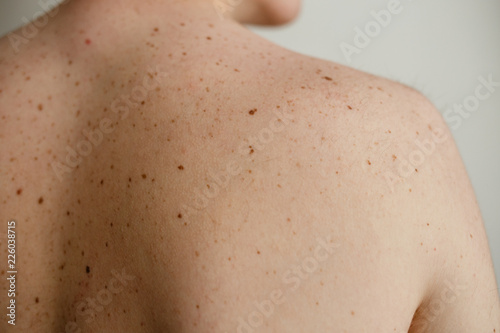 Close up detail of the bare skin on a man back with scattered moles and freckles , Disorders of body , Checking benign moles , Sun effect on skin. Birthmarks on skin