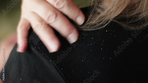 Problem skin with dandruff in a woman, close-up photo