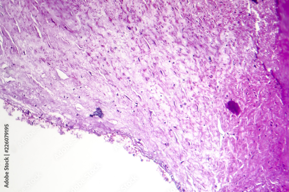 Coronary atherosclerosis, light micrograph showing cholesterol
