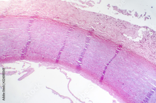Quadro em tela Fibrinoid necrosis of the vessel wall, light micrograph, photo under microscope