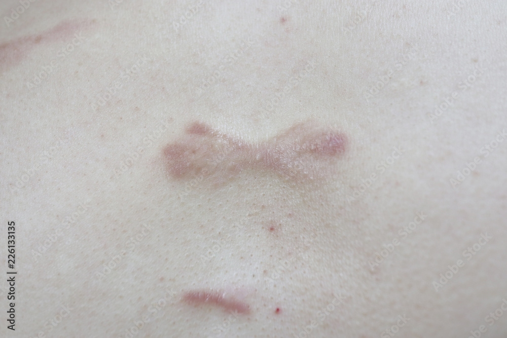 Fototapeta premium keloid skin
