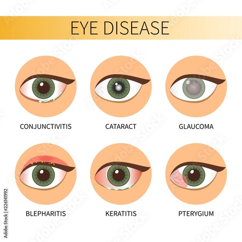 Eye diseases vector illustration. 