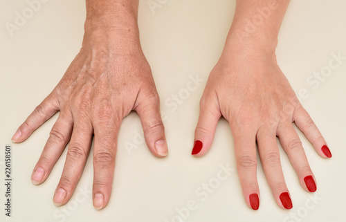 Bilde på lerret Hands of a woman before and after manicure and skin treatment