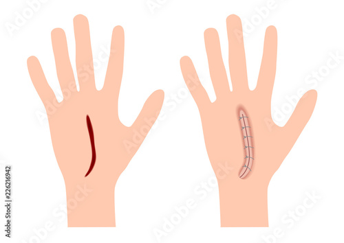 wound bleeding and hand skin graphic . anatomy vector