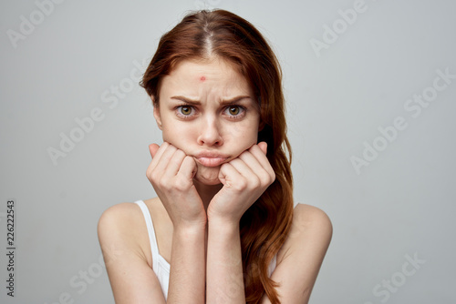 sad woman with acne on her face photo