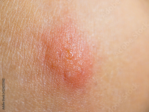 Insect bite on female skin
