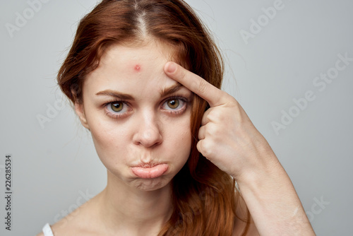 sad woman shows finger on pimple on forehead