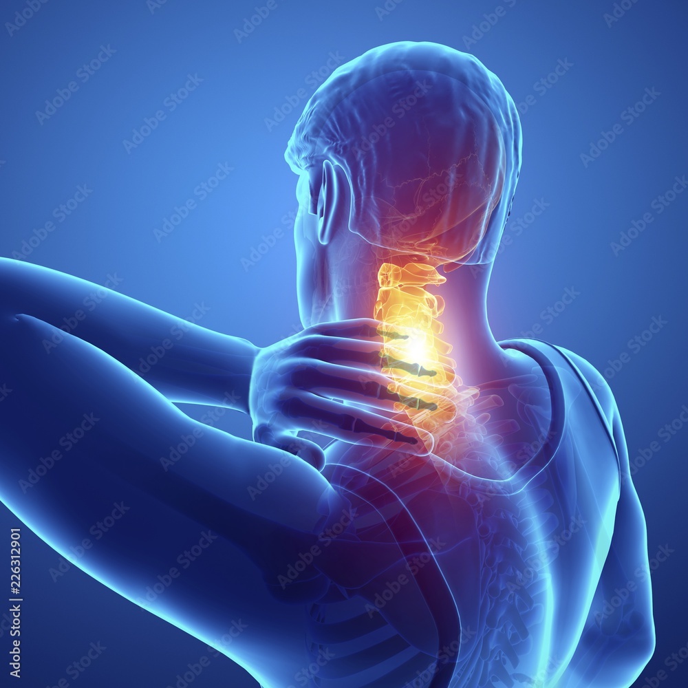 © Science RF - Man with neck pain, illustration