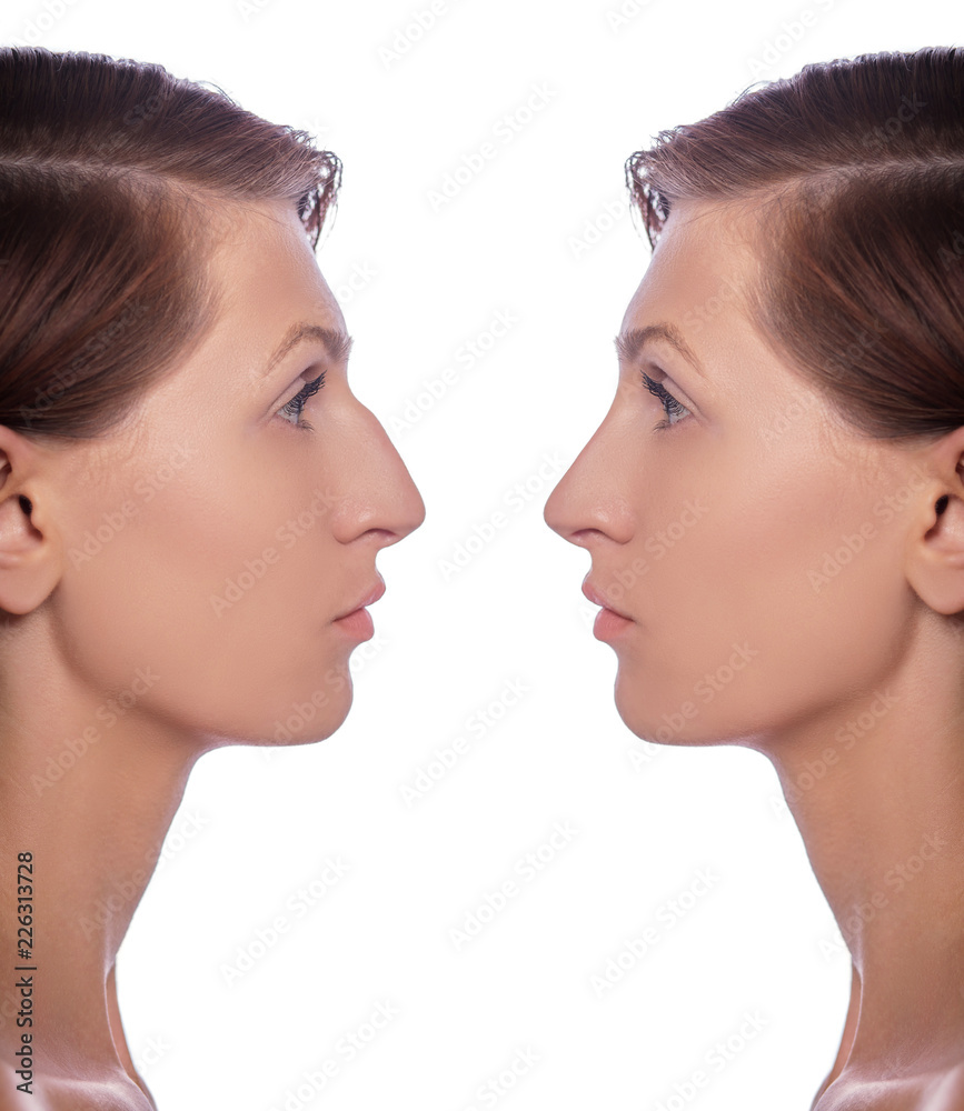 profile female before and after plastic surgery on her nose. Comparison of woman nose after plastic surgery profile female before and after plastic surgery on her nose. Comparison of woman nose after plastic surgery