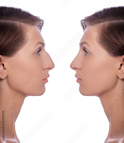 profile female before and after plastic surgery on her nose. Comparison of woman nose after plastic surgery