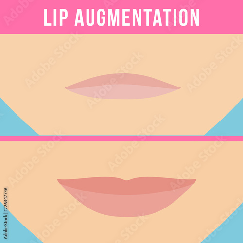 Woman makes procedure of beauty injection for lip augmentation. Lips before and after hyaluronic acid lip filler injection. Vector