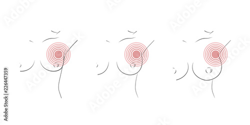 Breast self exam ill