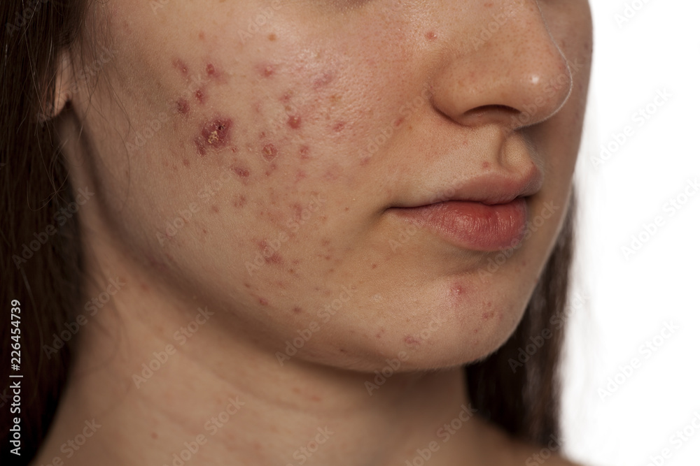 Obraz premium closeup of teenage girl with problematic skin on white background