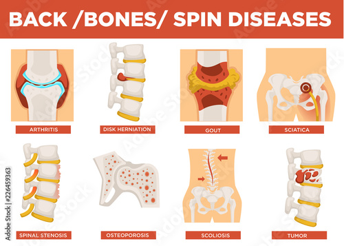 Back, bones and human spin diseases explanation vector