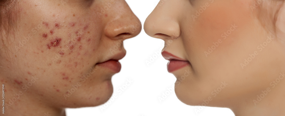 comarision portratit of teenage girl with problematic skin, before and after skin traitment on white background comarision portratit of teenage girl with problematic skin, before and after skin traitment on white background