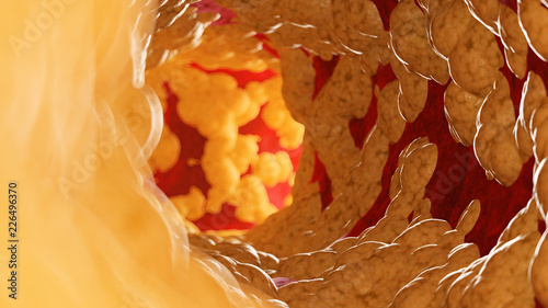 3d rendered medically accurate illustration of fat inside of an artery photo