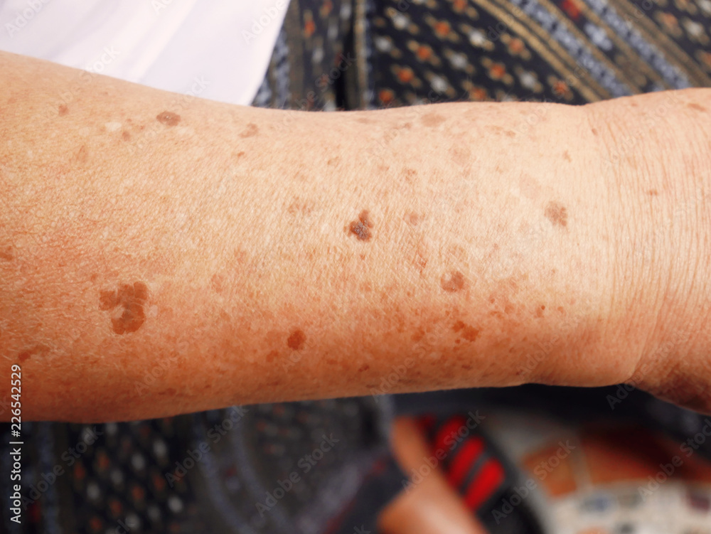 Dark spots on the skin on the arm. Stock Photo Adobe Stock