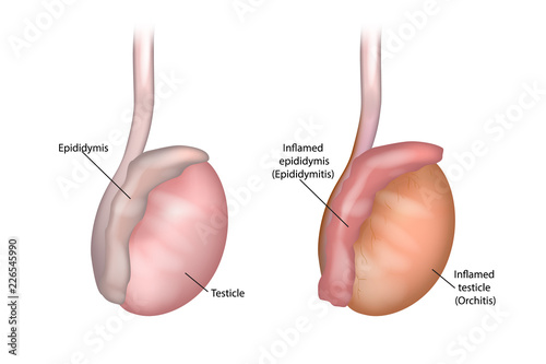 Illustration of the testicle and epididymis. Epididymitis (Inflamed epididymis) And Orchitis photo