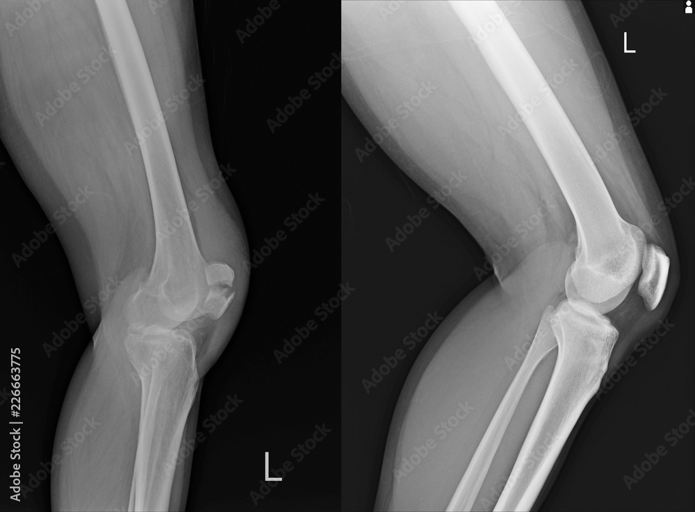 Xray Left Knee lateral Showing Kneecap fracture and Normal. Stock Photo Adobe Stock
