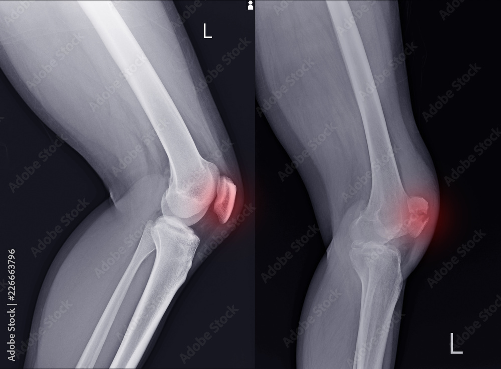 Xray Left Knee lateral Showing Kneecap normal and fracture red color