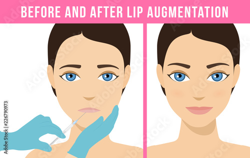 Woman makes procedure of beauty injection for lip augmentation. Lips before and after hyaluronic acid lip filler injection. Vector