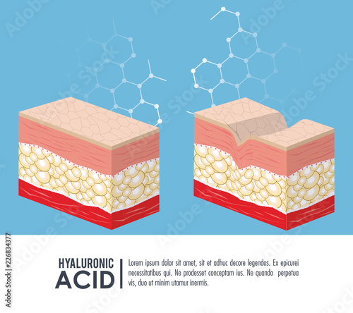 hyaluronic acid filler injection infographic