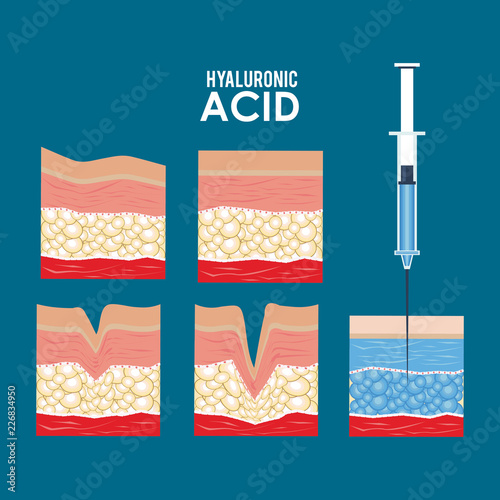 hyaluronic acid filler injection infographic