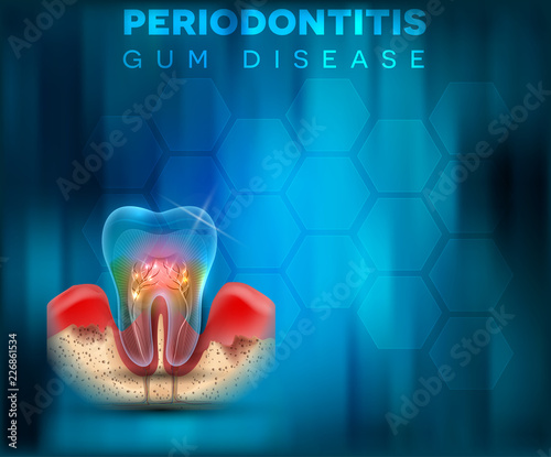 Periodontitis gum disease poster, inflammation of the gums on a bright blue mesh background photo