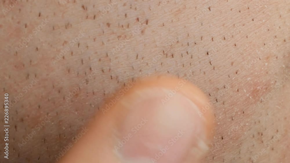 mother's mark on male skin of face mother's mark on male skin of face