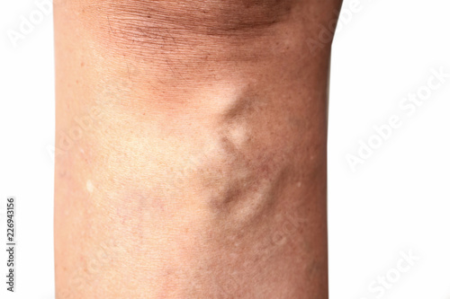 varicose veins on female leg isolated on white background  © doucefleur