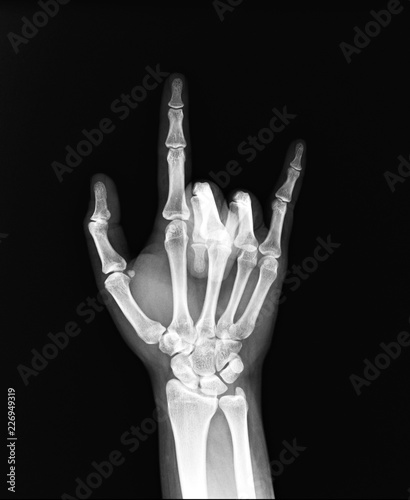 X-ray of the hands