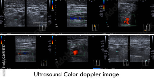 Ultrasound color doppler image:Normal doppler signal of superficial femoral v. and popliteal v. bilaterally.No sign of thrombus in the veins. photo