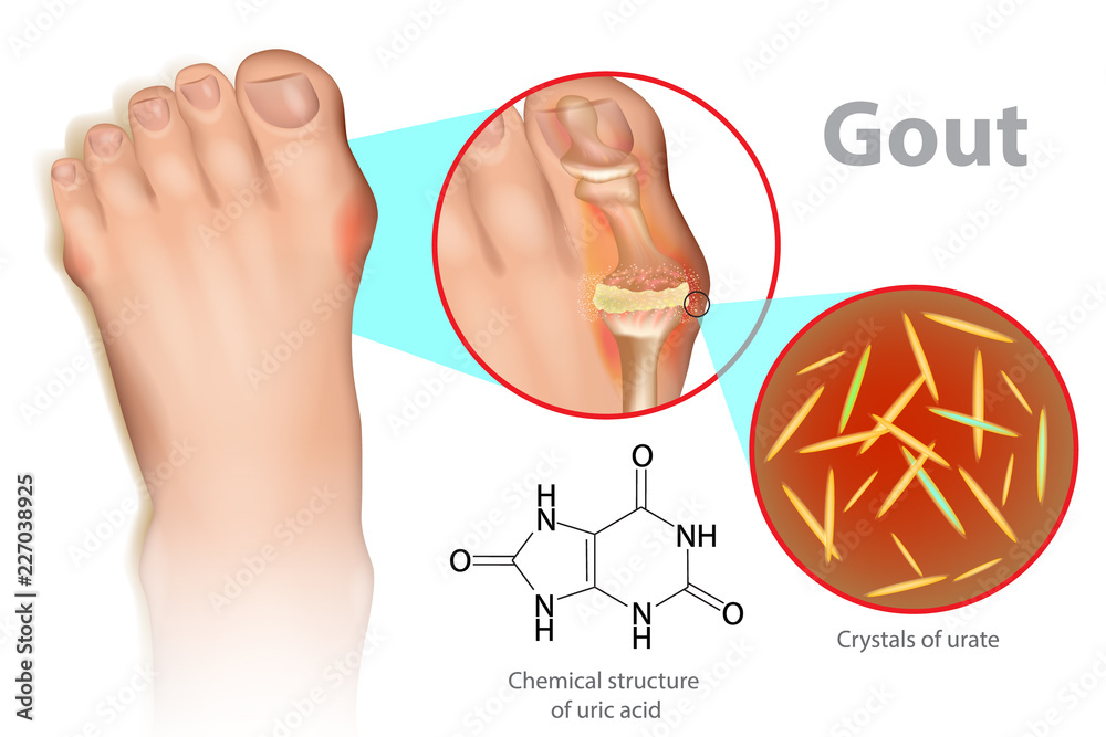 Vetor de Illustration of foot with gout. Gout is a form of inflammatory ...