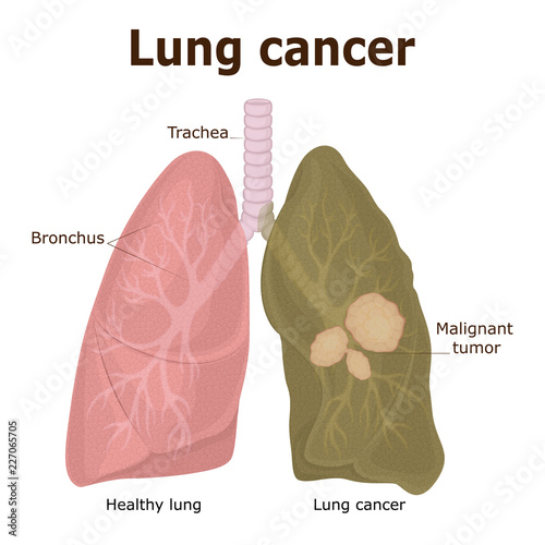 Illustration of lung cancer