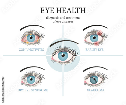 Most common eye problems - conjunctivitis, glaucoma, dry eye syndrome, barley eyes.