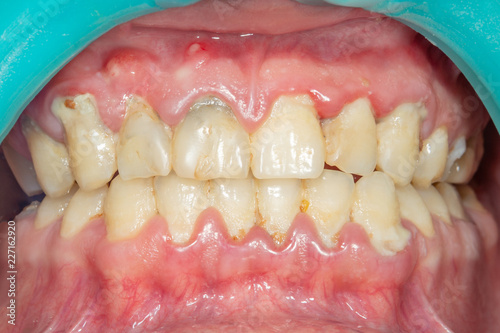 Close-up of a person's teeth after removing and cleaning a plaque in a dental clinic. Healthy smile concept