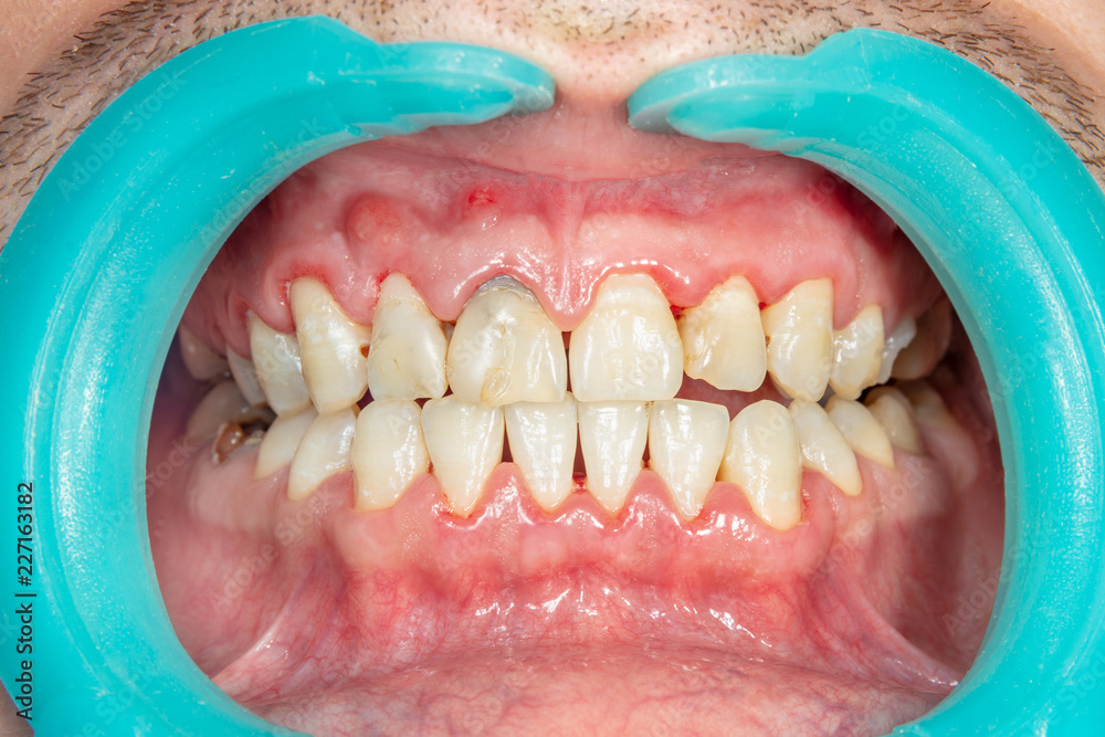 Obraz premium Close-up of a person's teeth after removing and cleaning a plaque in a dental clinic. Healthy smile concept