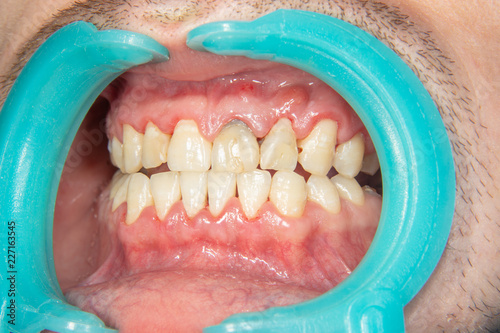 Human teeth closeup with dental plaque and inflammation of gingivitis. Concept of brushing teeth and poor hygiene