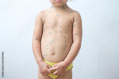Child with chickenpox. Sick little girl  with varicells making eruption on skin. Long home quarantine, then having immunity for ever. photo