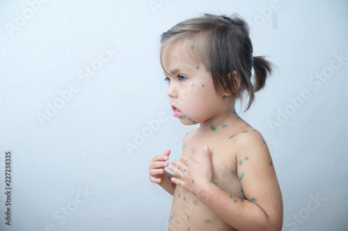 kid with chickenpox. Sick little girl  with varicells making eruption on skin. Child on long home quarantine, then having immunity for ever. photo