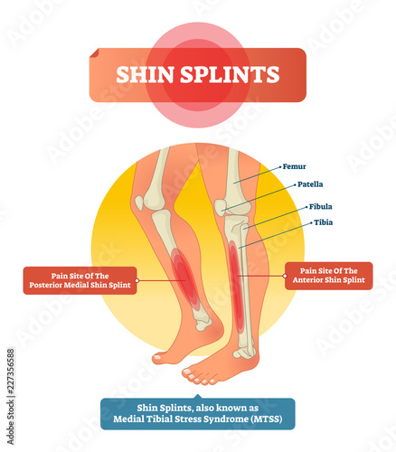 Shin splints vector illustration. Leg muscle sport trauma and bone pain. photo