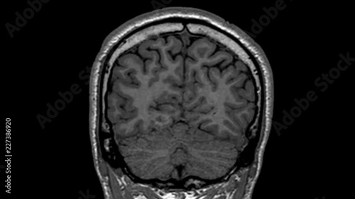 Magnetic Resonance Imaging scan from the coronal view of a human brain photo