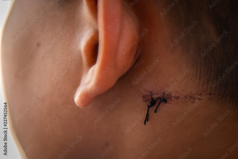 Obraz premium The wound was sewn with black yarn due to torn skin.