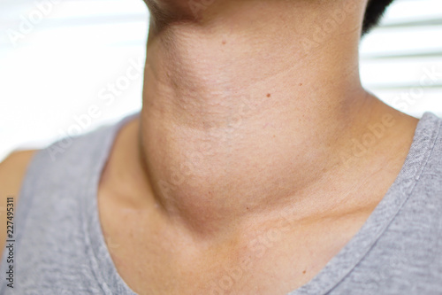 Asian lady woman patient have abnormal enlargement of thyroid gland Hyperthyroidism (overactive thyroid) at the throat : healthy strong medical concept 