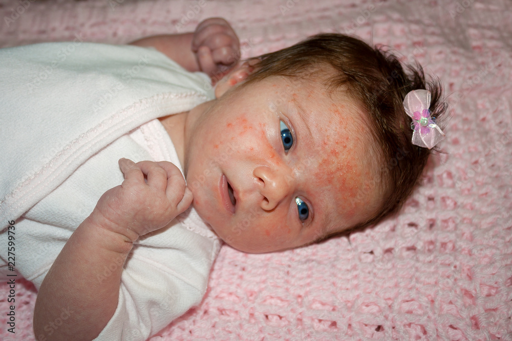 Can Babies Be Born With Freckles