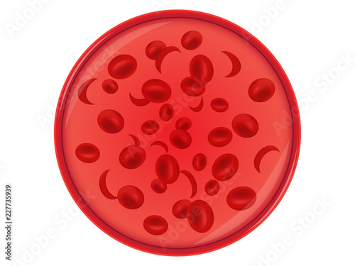 Sickle cell anemia