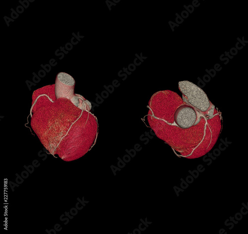 Front and Top view of CTA Coronary artery  3D rendering image. CT angiographphy for heart disease . Medical technology concept. photo