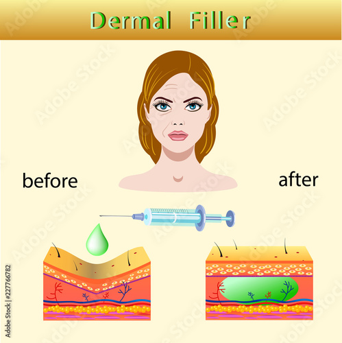 Vector illustration with cosmetic filler or Dermal fillers on light background