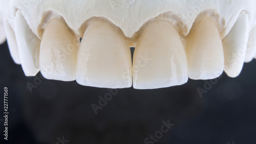 Ceramic teeth on a plaster model with a black background