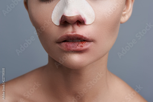 Unpleasant photo of young lady having blood on her nose and lips